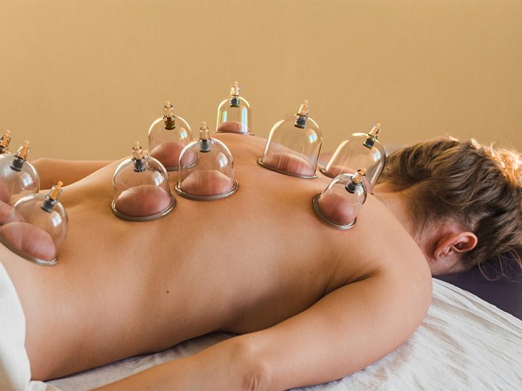 Cupping therapy on the back to improve circulation and relieve muscle tension