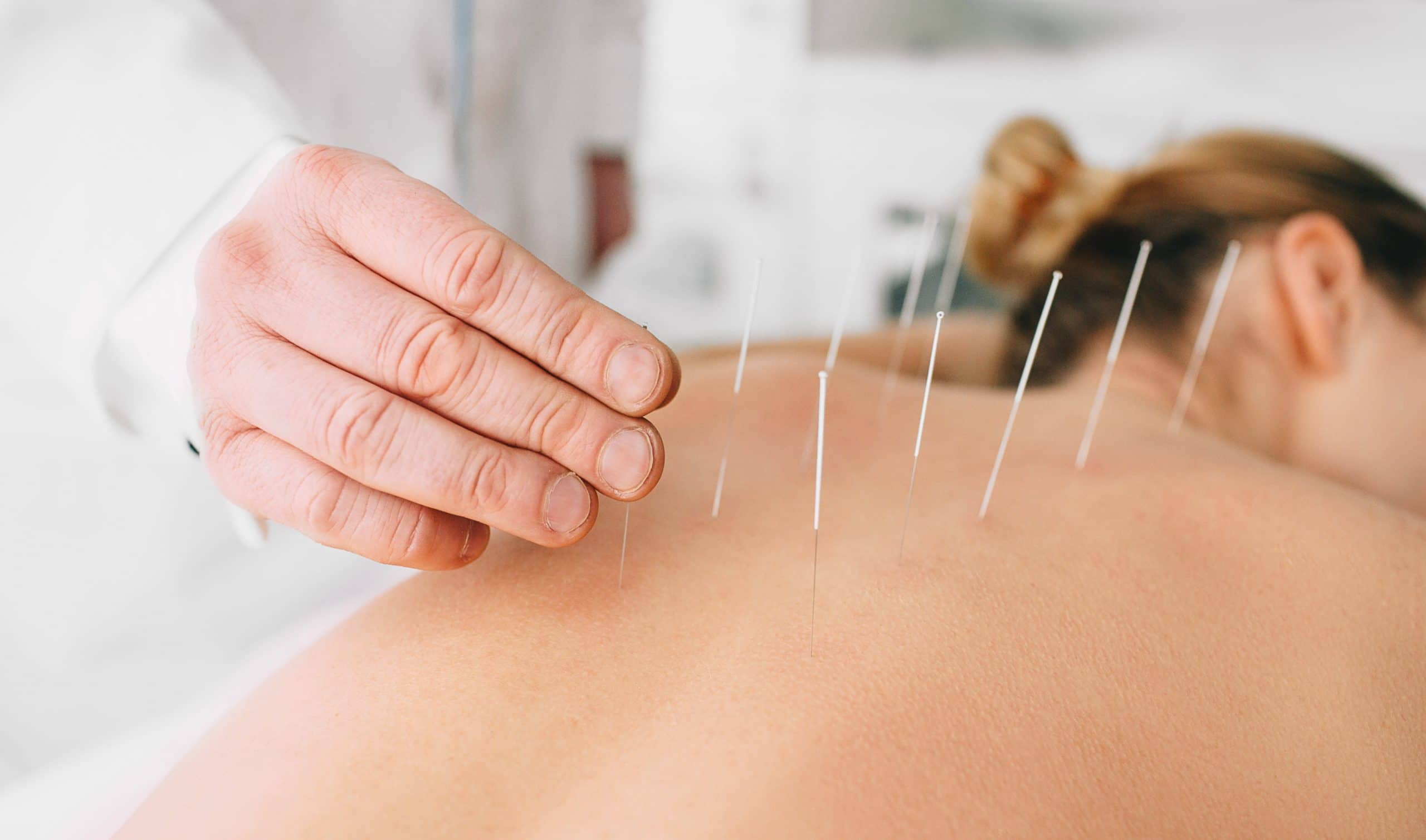 Acupuncture treatment on meridian points for pain relief and health balance