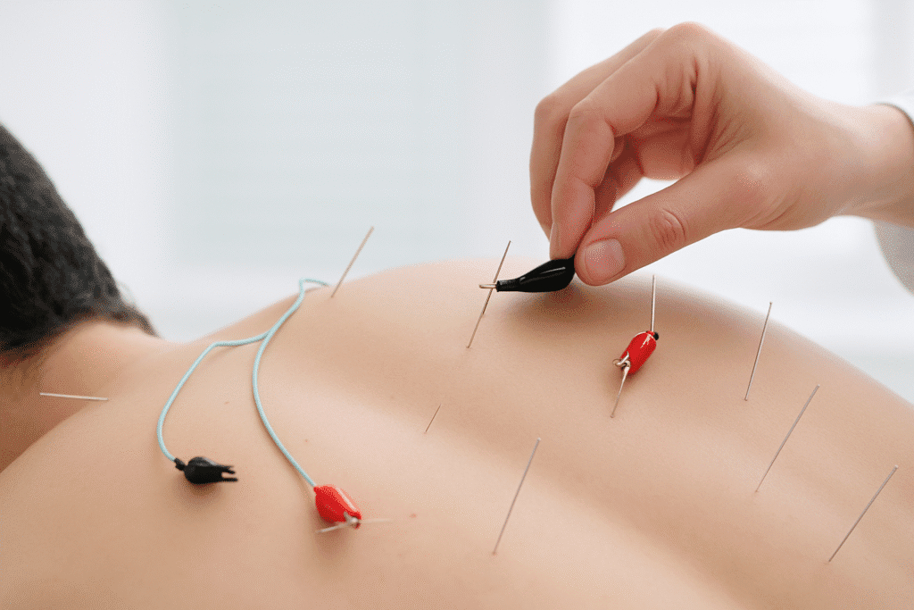 “Electro-acupuncture needles connected to mild electrical stimulation for nerve pain relief.